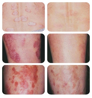 Por que ungüentos curan la psoriasis